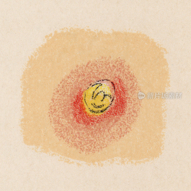 医学插图人类皮肤闭合的粉刺(白头)发展成丘疹(脓疱)与寻常痤疮- 19世纪